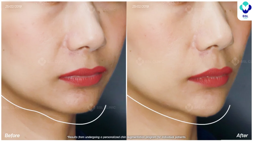 ยกกระชับหน้า