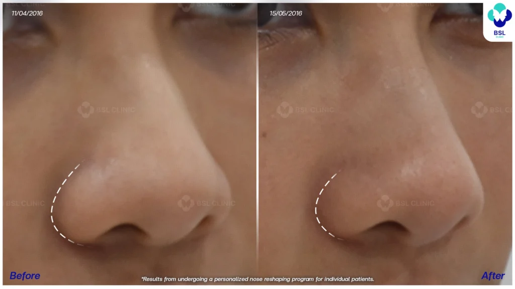 ผลลัพธ์ยกกระชับหน้า