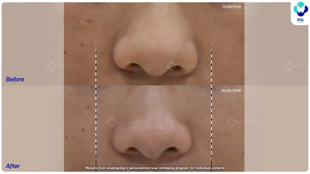 ผลลัพธ์ยกกระชับหน้า