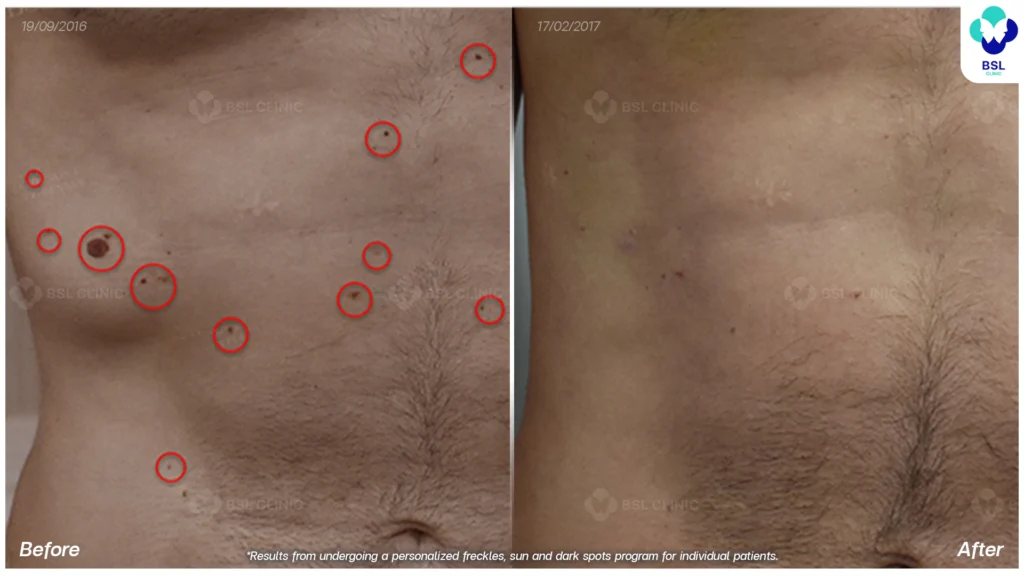 ตัวอย่างเคสกระ BSL