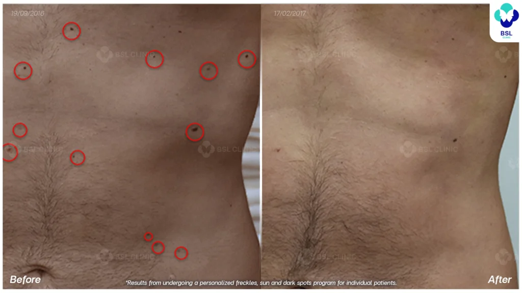 ตัวอย่างเคสกระ BSL