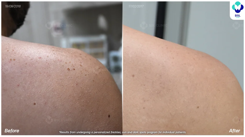 ตัวอย่างเคสกระ BSL