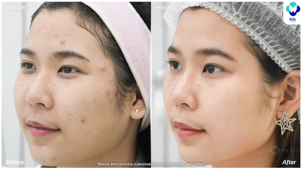 รักษาสิวอักเสบ