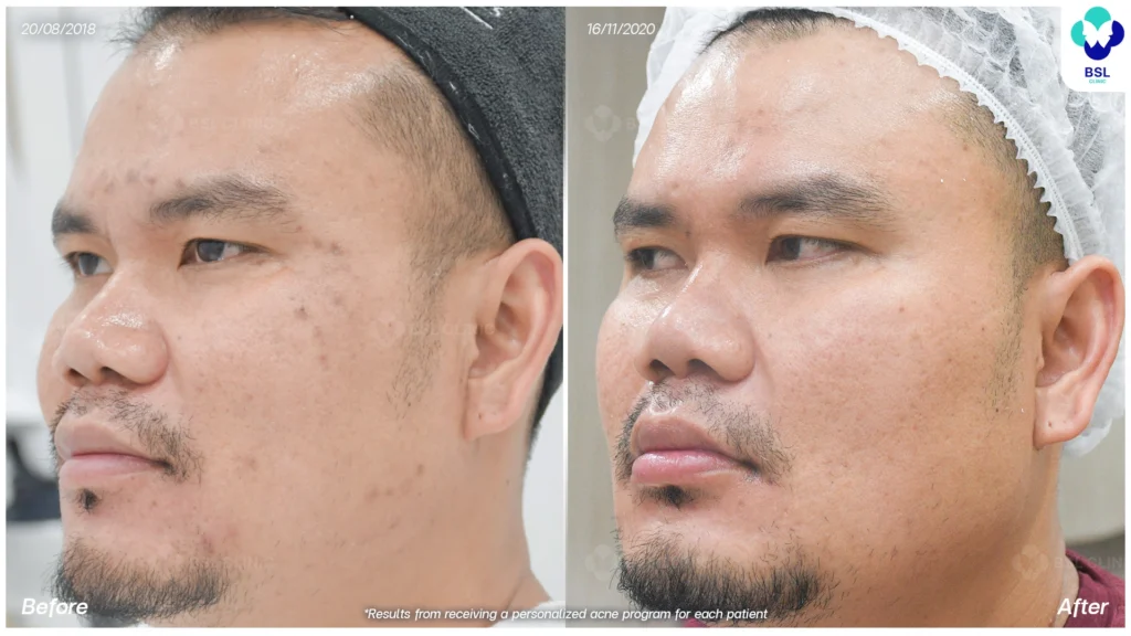 สิวในผู้ชาย