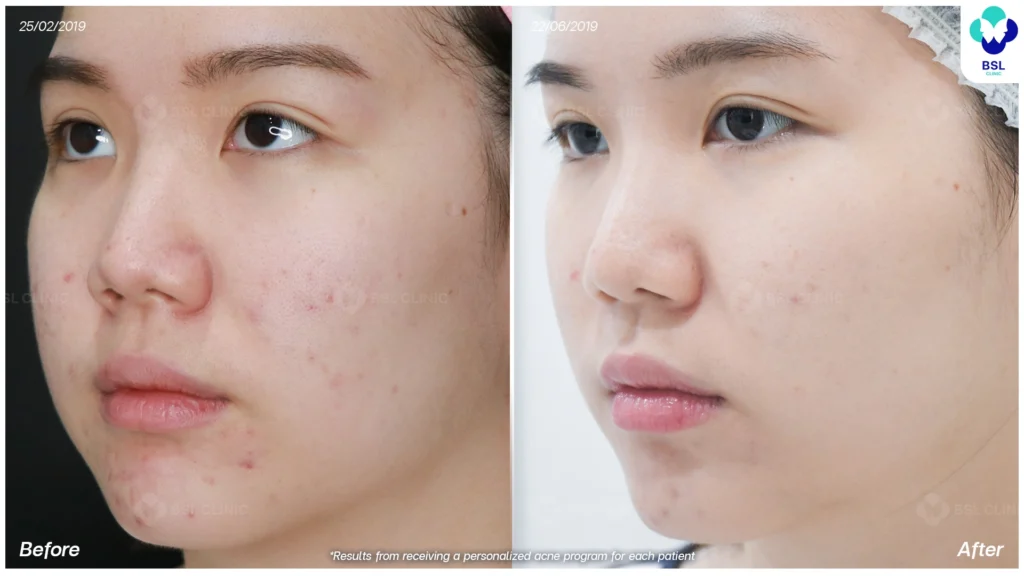 สิวบนใบหน้า