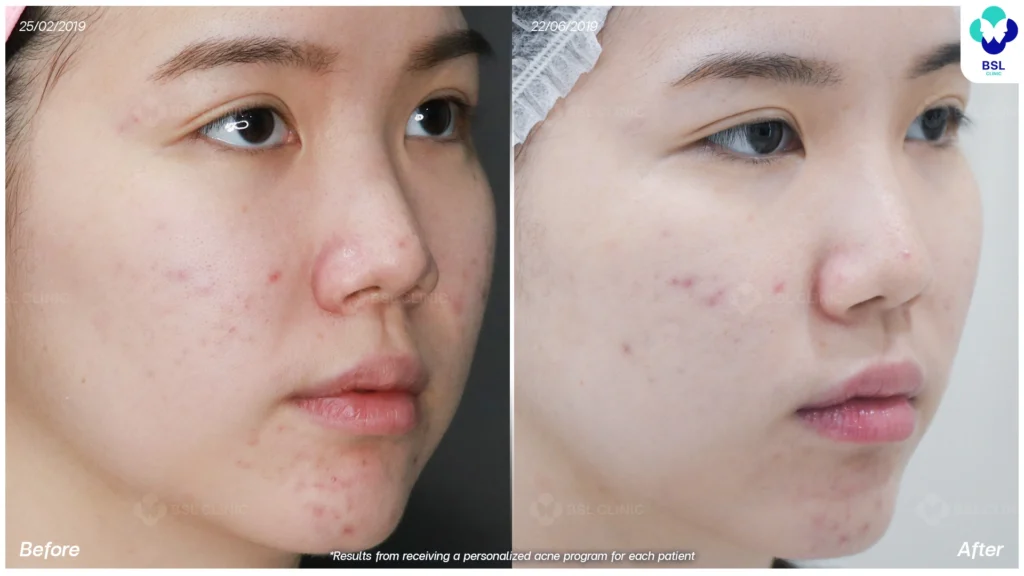 สิวบนใบหน้า