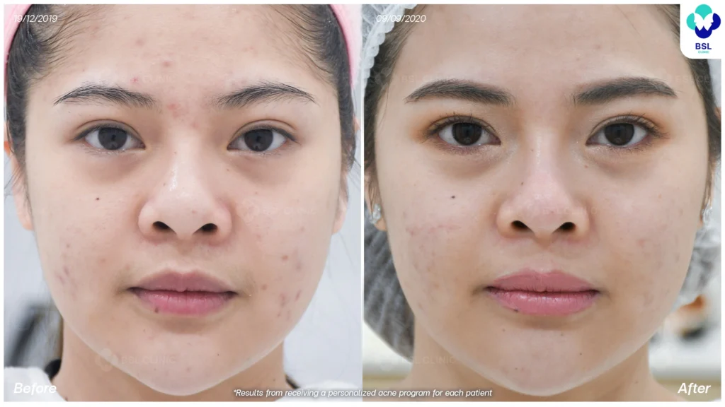 รีวิวรักษารอยแดงสิว