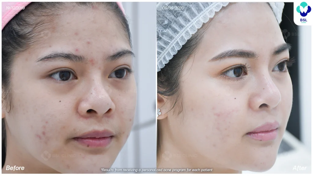 รีวิวรักษารอยแดงสิว