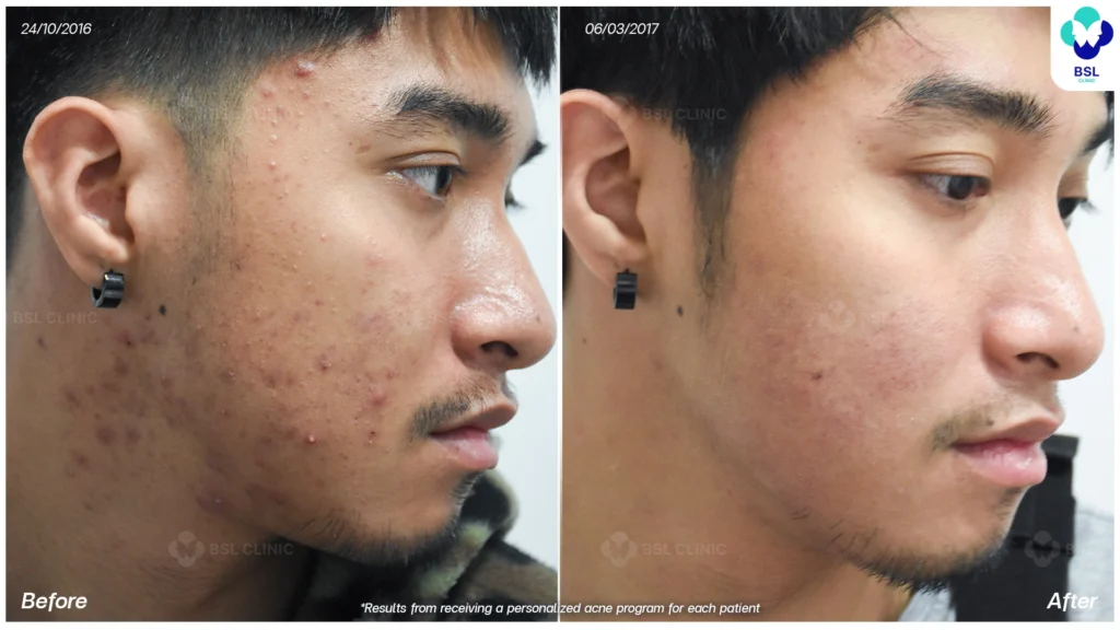 รีวิวรักษาสิวอักเสบ