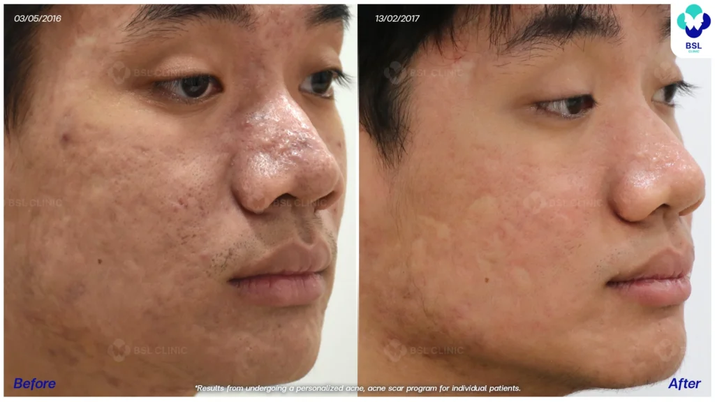 แผลเป็นจากหลุมสิว