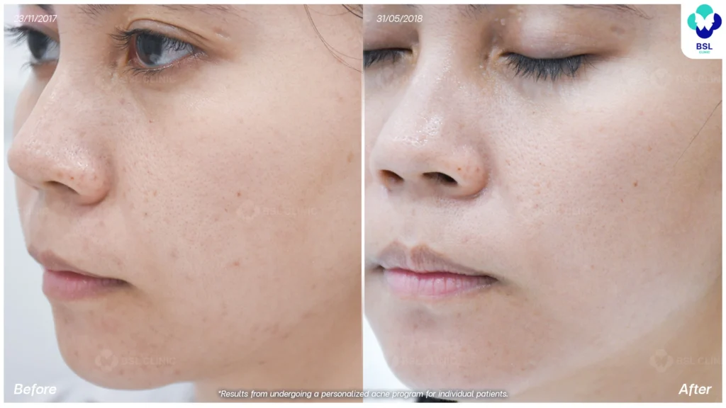 รีวิวรักษาผิวแพ้ง่าย