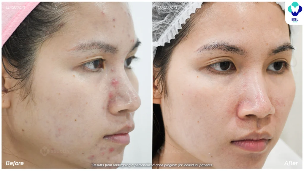 สิวเห่อขึ้นที่หน้า