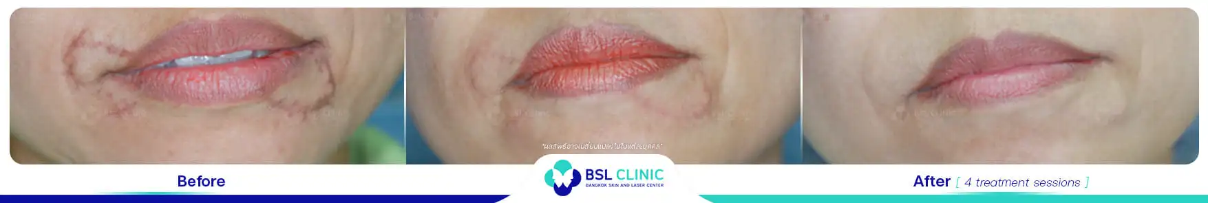 รอยแผลเป็น