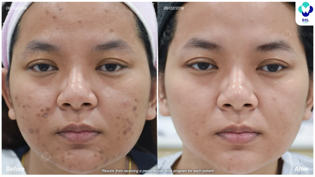 สิวบนใบหน้า