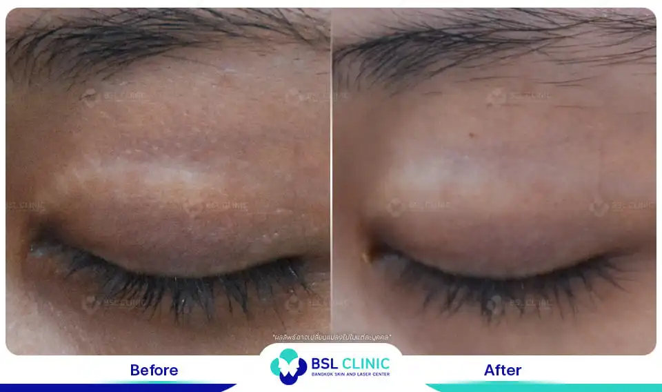 รักษารอยแปลเป็น