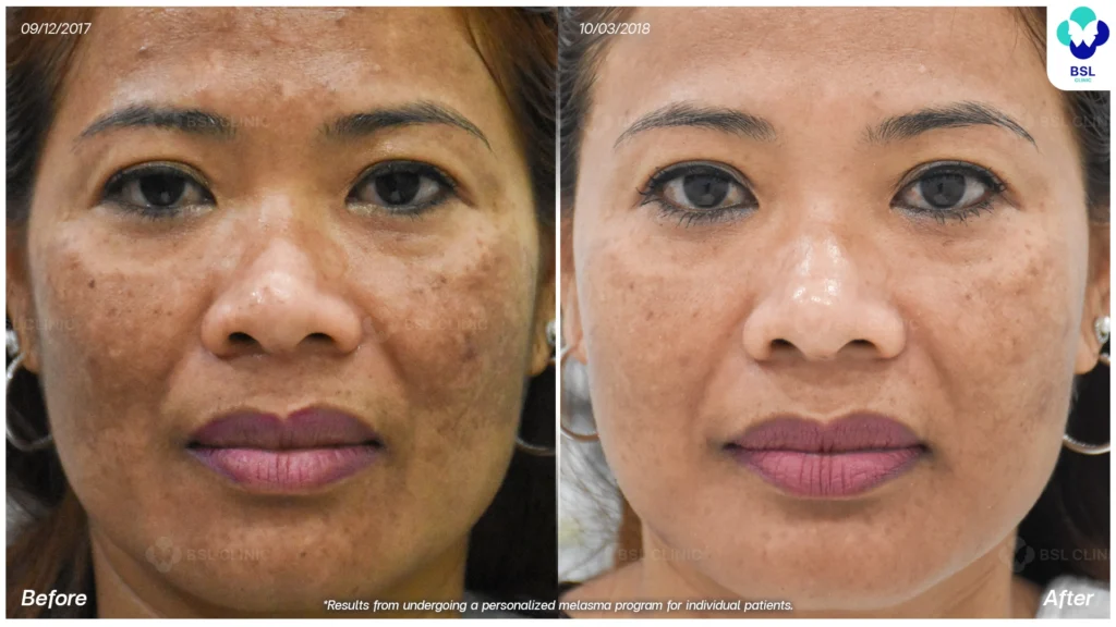 ผลลัพธ์การดูแลฝ้ารอบแก้ม