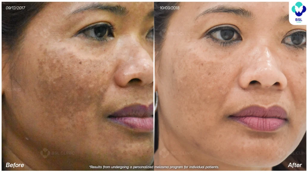 ผลลัพธ์การดูแลฝ้ารอบแก้ม