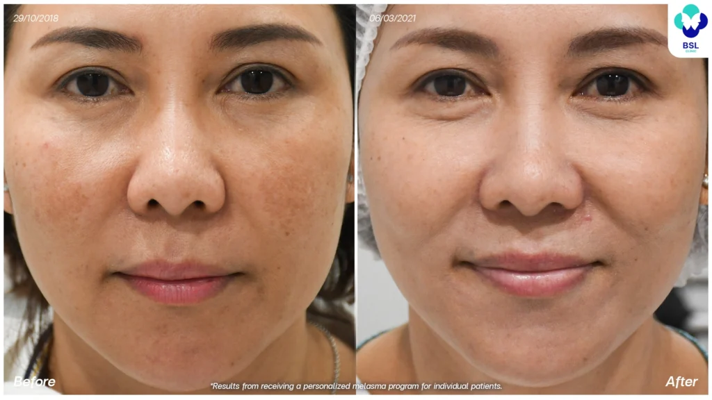 แบ่งปันประสบการณ์ดูแลฝ้า