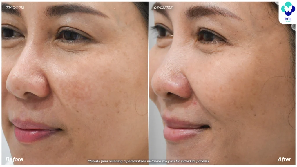 แบ่งปันประสบการณ์ดูแลฝ้า