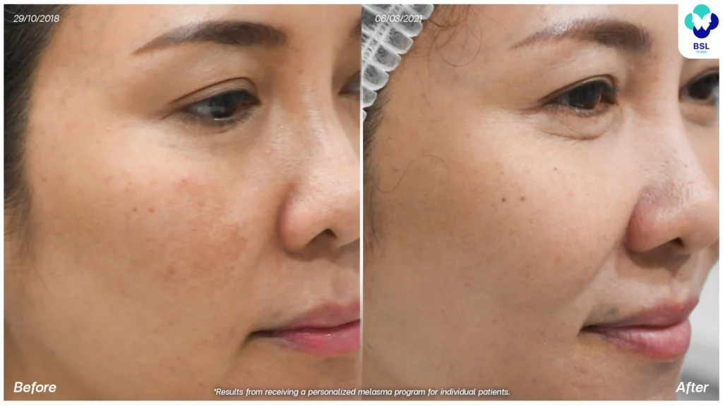 แบ่งปันประสบการณ์ดูแลฝ้า