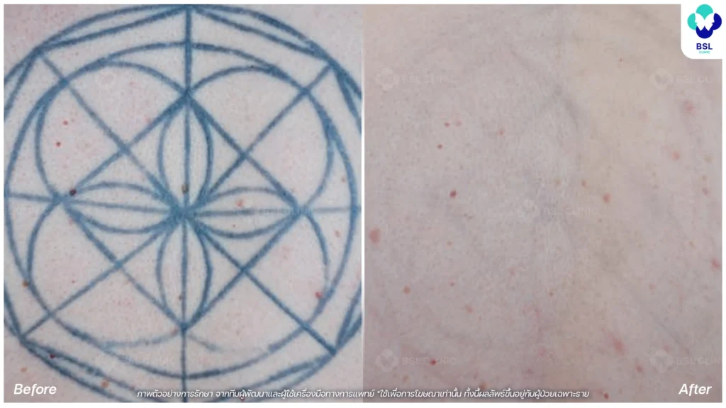 ลบรอยสัก