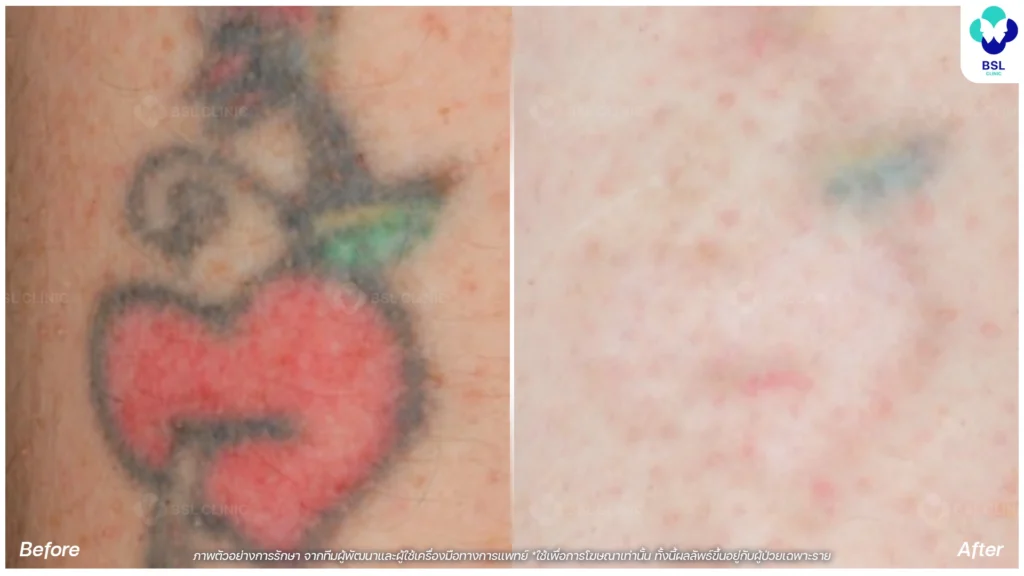 ลบรอยสัก