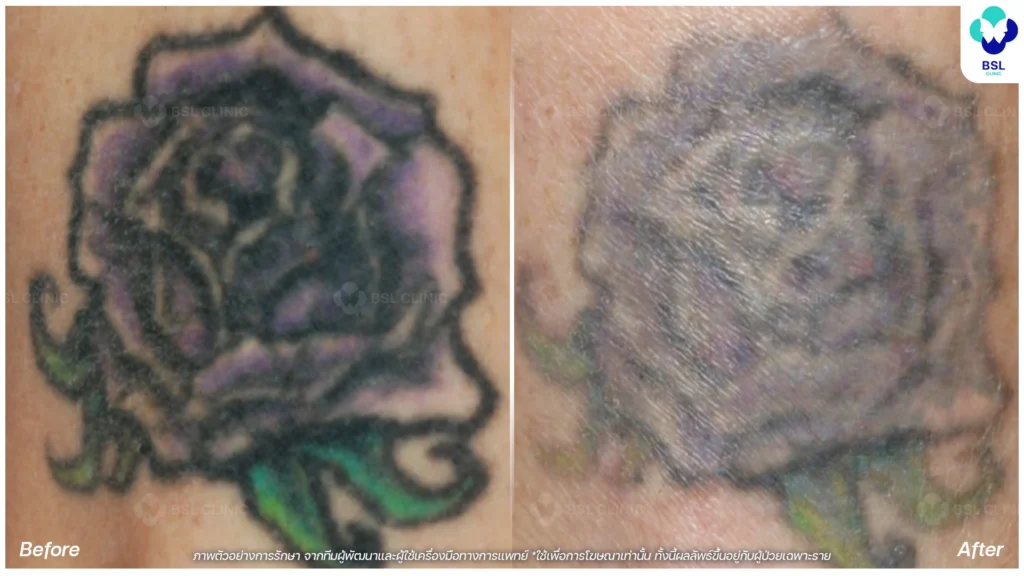 รีวิวลดรอยสักจางลง