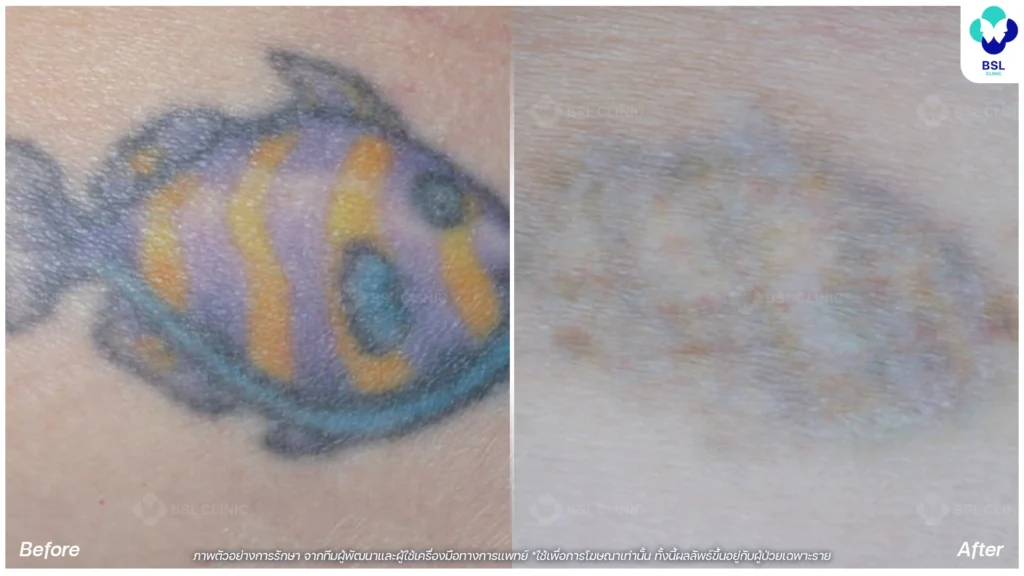 รีวิวลดรอยสักจางลง