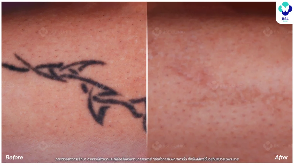 รีวิวลดรอยสัก