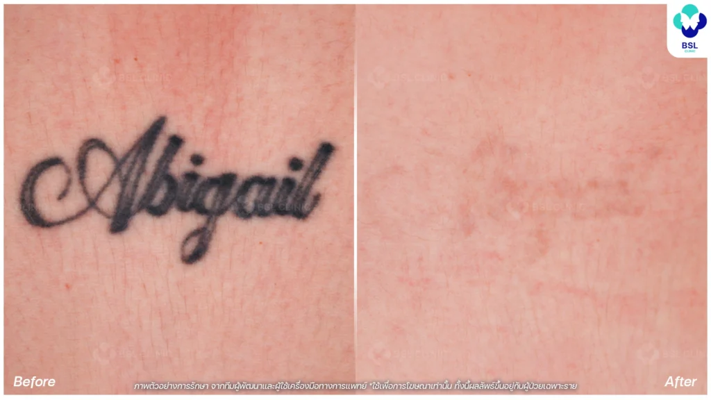 รีวิวลดรอยสัก