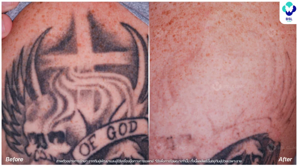 ลบรอยสัก