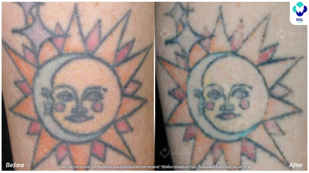 รีวิวลดรอยสักจางลง