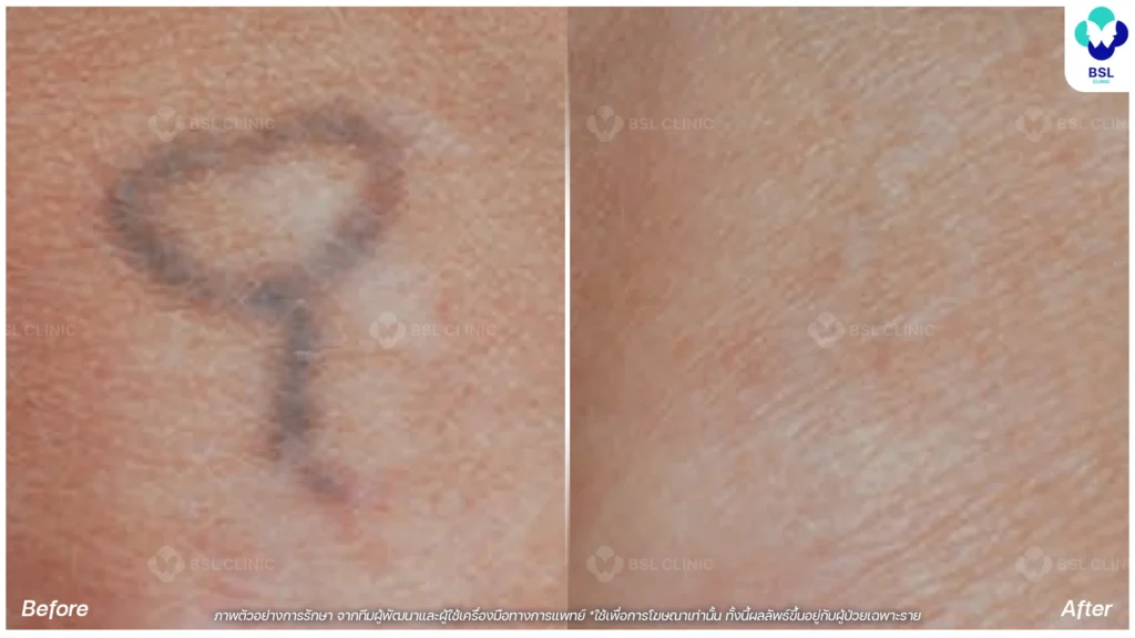 ลบรอยสัก