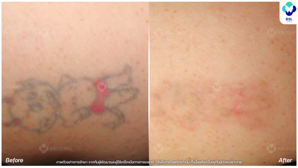 รีวิวลดรอยสัก