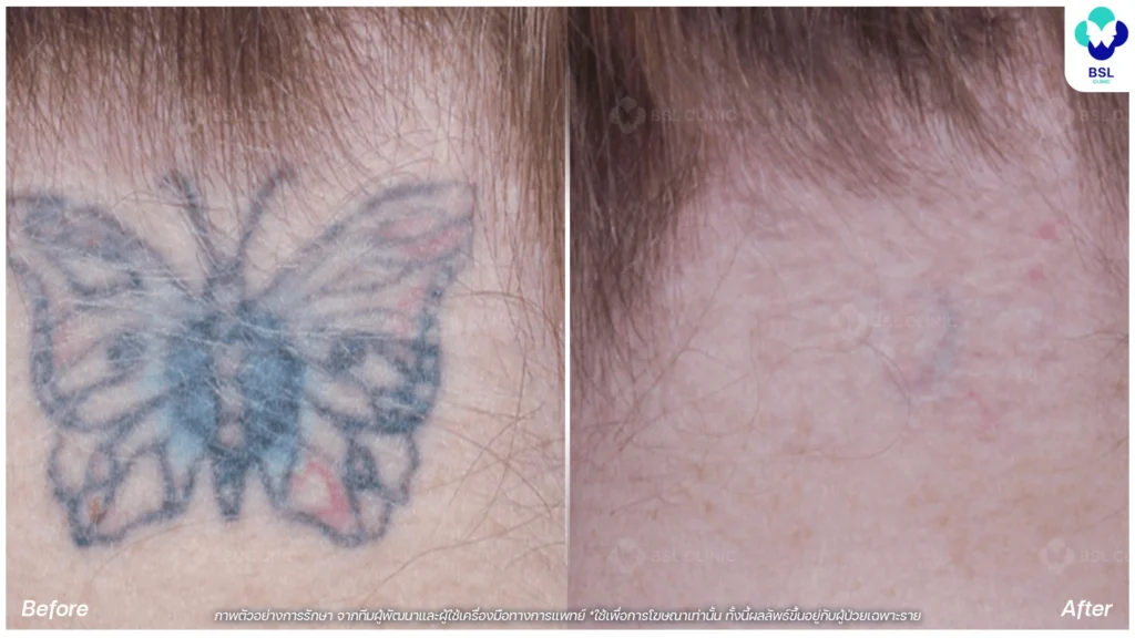 ลบรอยสัก