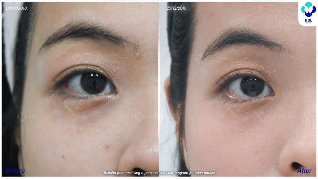 แผลเป็นและสีผิวดูกลมกลืนมากขึ้น