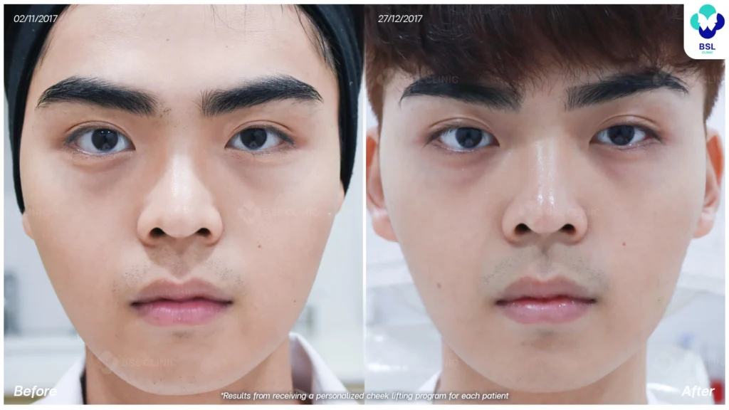 รีวิวยกกระชับปรับรูปหน้า