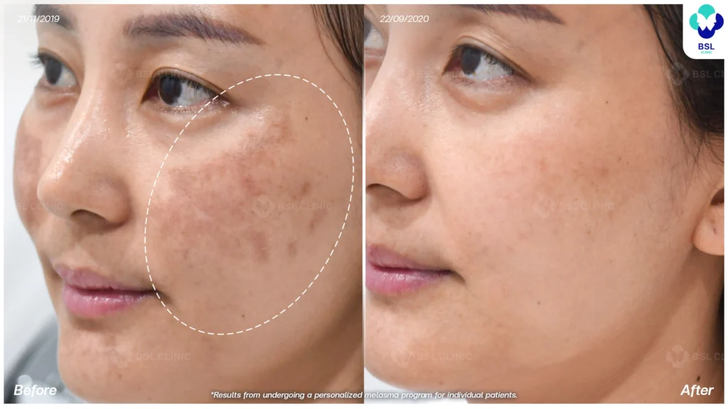 แบ่งปันประสบการณ์ดูแลฝ้า