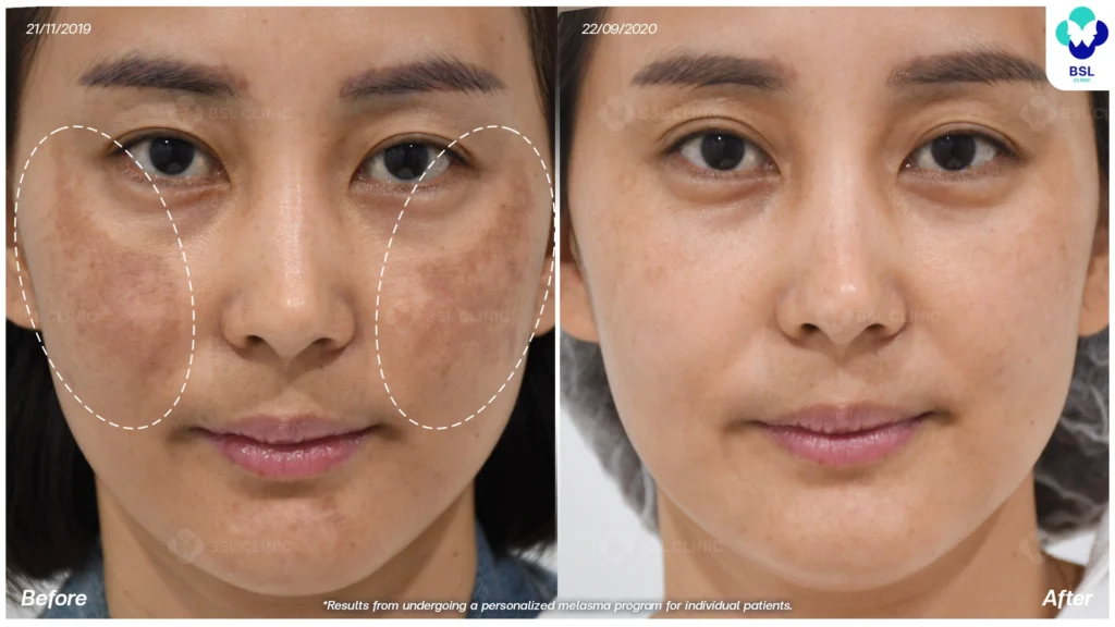 แบ่งปันประสบการณ์ดูแลฝ้า