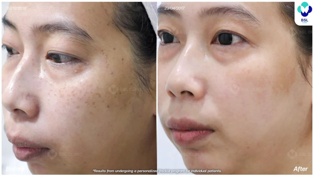 เคสกระร่วมกับจุดด่างดำบนใบหน้า