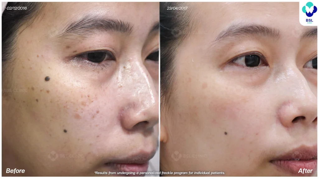 เคสกระร่วมกับจุดด่างดำบนใบหน้า