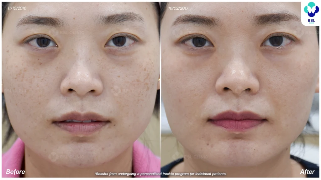 ตัวอย่างเคสกระ BSL