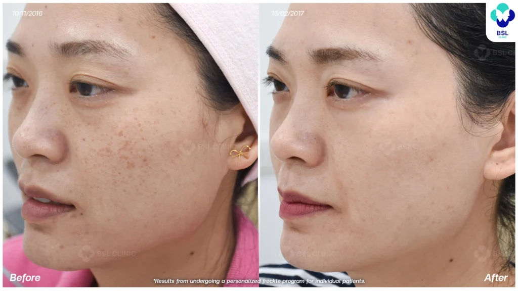 ตัวอย่างเคสกระ BSL