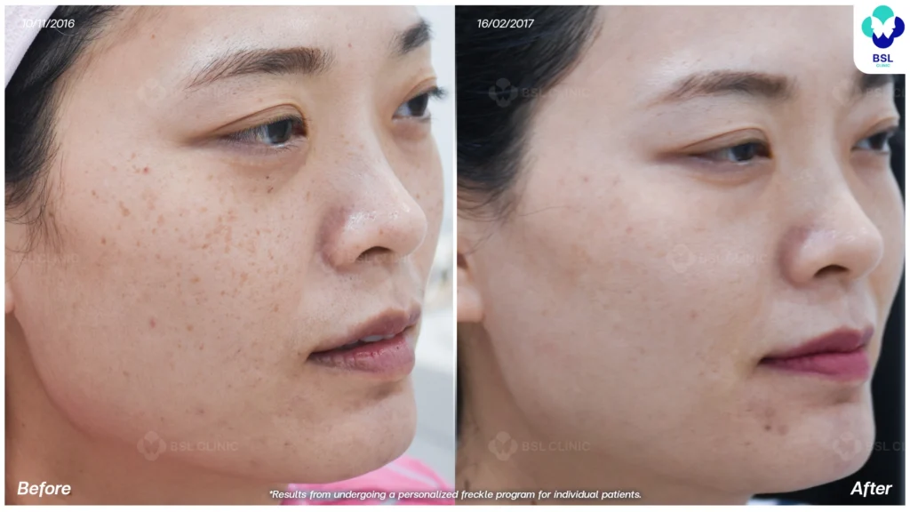 เคสกระร่วมกับจุดด่างดำบนใบหน้า