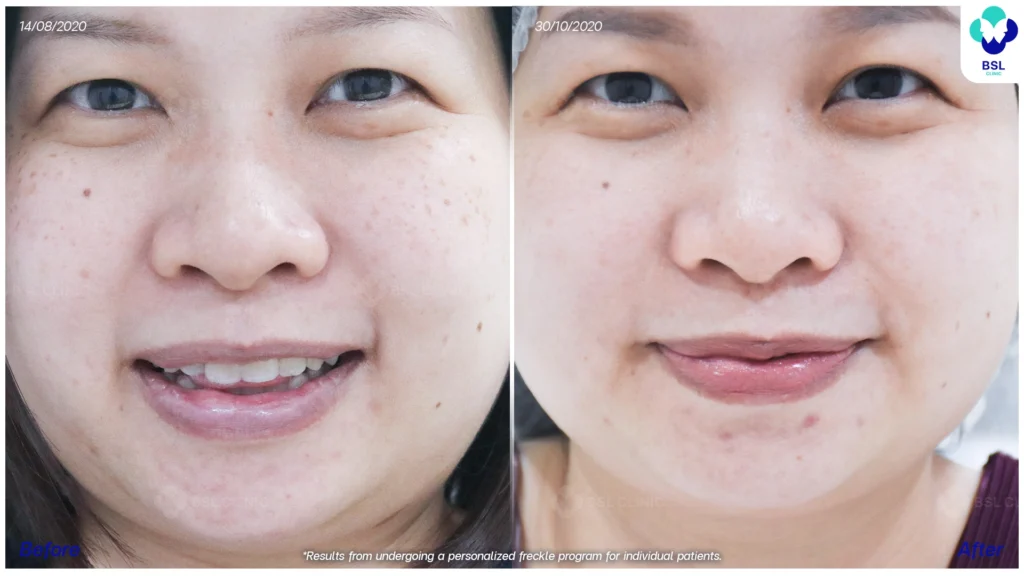 ภาพการเปลี่ยนแปลงของกระหลังดูแลต่อเนื่อง