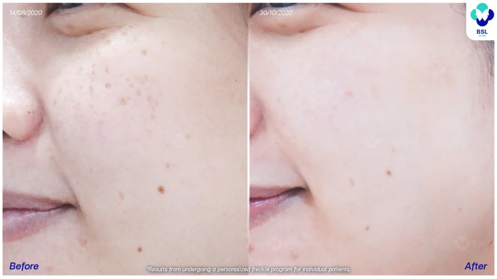 ภาพการเปลี่ยนแปลงของกระหลังดูแลต่อเนื่อง