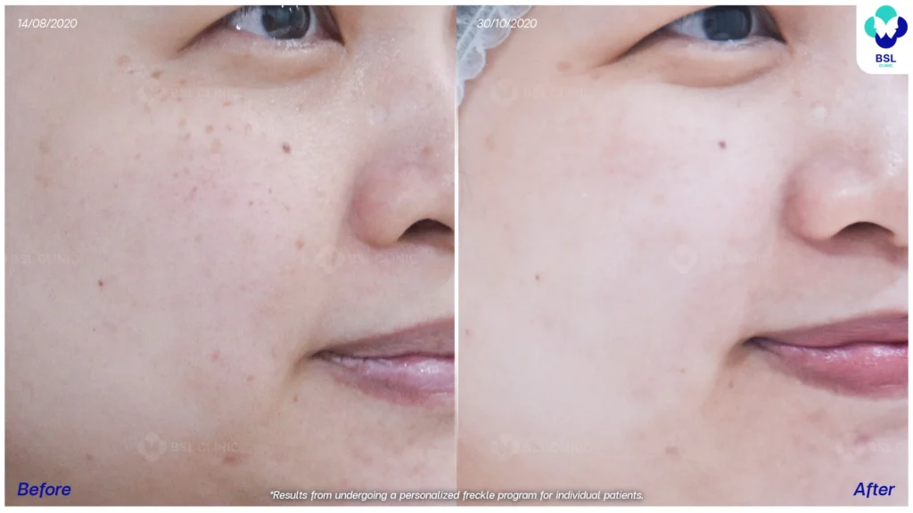 ภาพการเปลี่ยนแปลงของกระหลังดูแลต่อเนื่อง