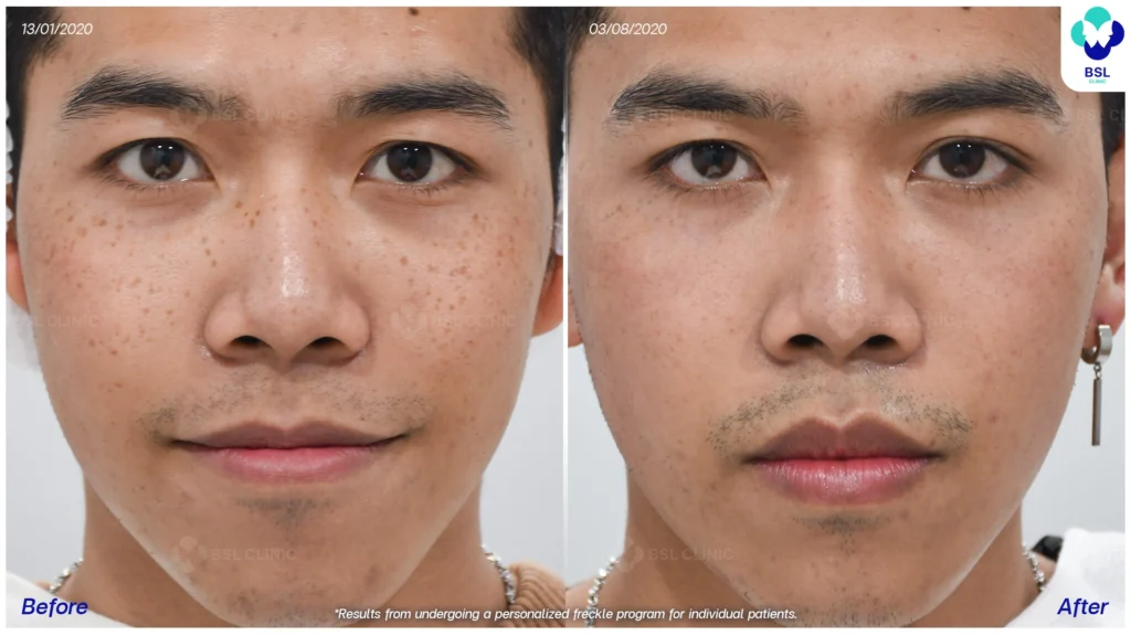 เคสกระแดดในวัยทำงาน