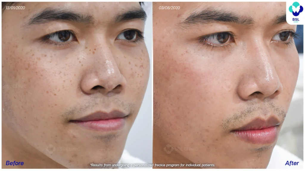 เคสกระแดดในวัยทำงาน