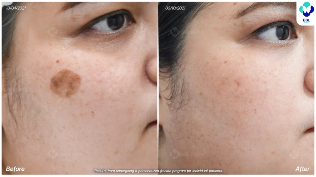 กระบริเวณใบหน้าก่อน–หลังโปรแกรมดูแลผิว